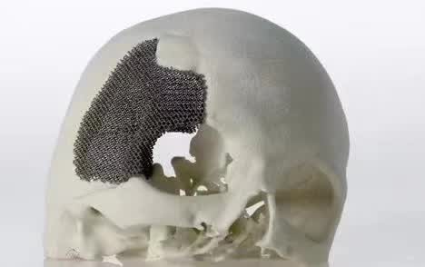 顱骨3D打印技術(shù)是什么？